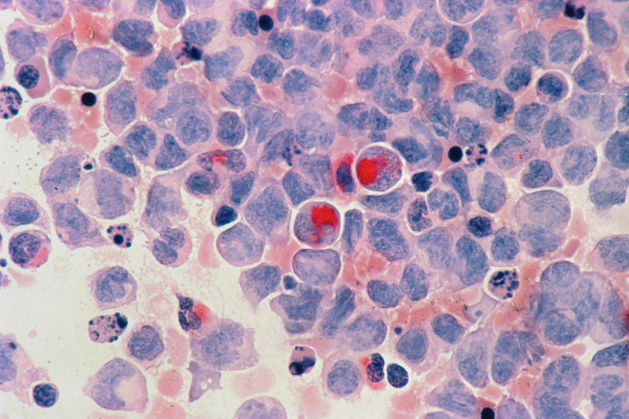 Close-up of tumor cells.